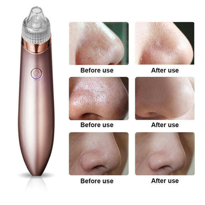 Electric Blackhead Remover - Beauty Touch Essentials